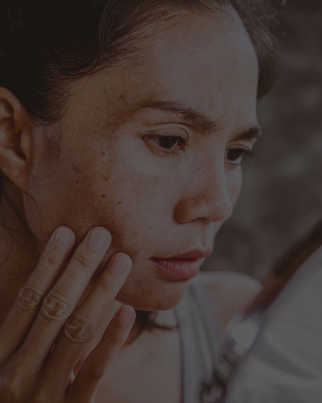 Manchas na Pele: Como Prevenir e Tratar no Verão