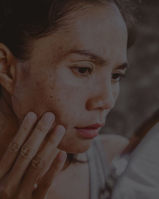 Manchas na Pele: Como Prevenir e Tratar no Verão